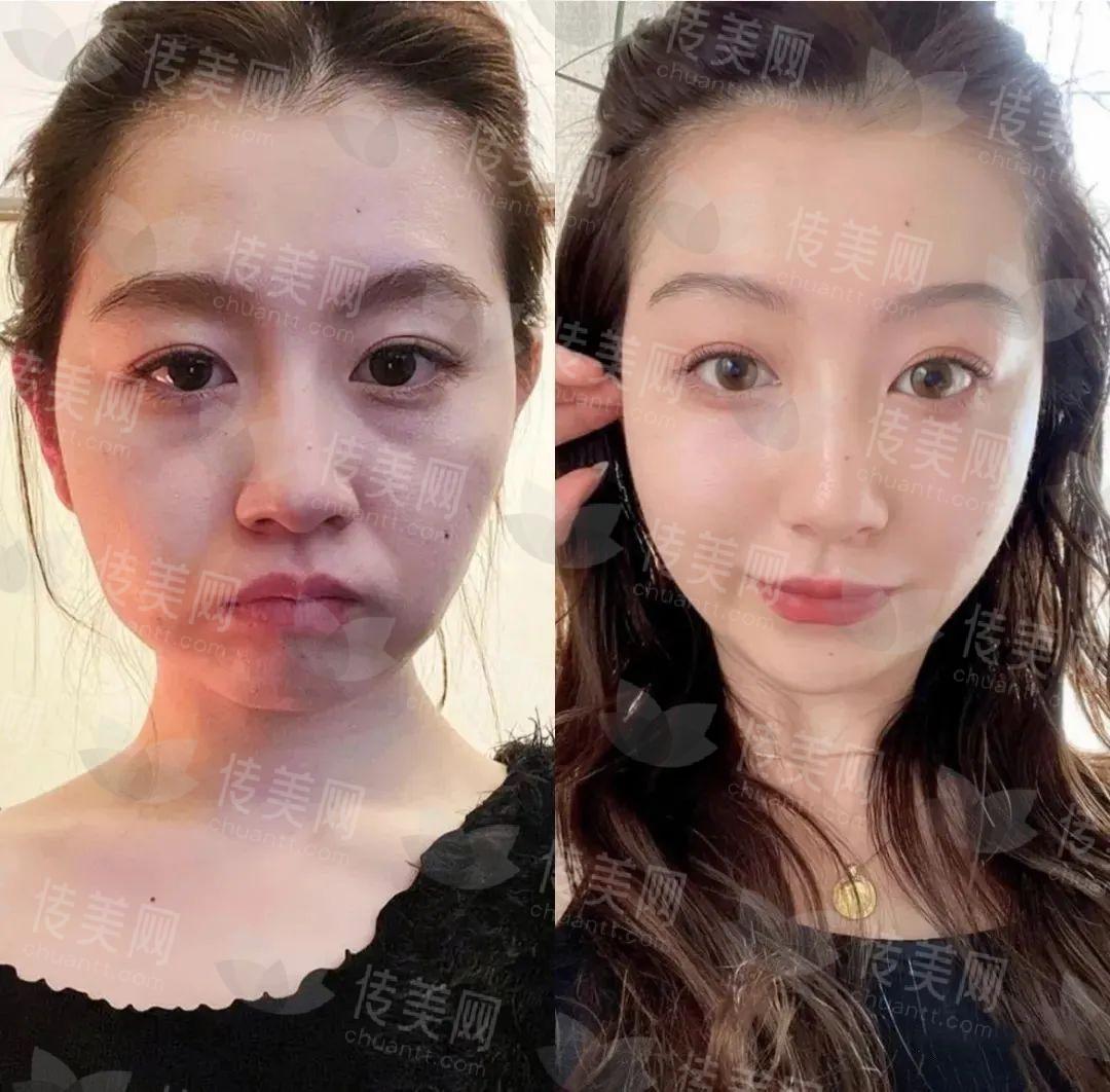 小拉皮术后反馈!带你了解拉皮手术后,到底年轻几岁!
