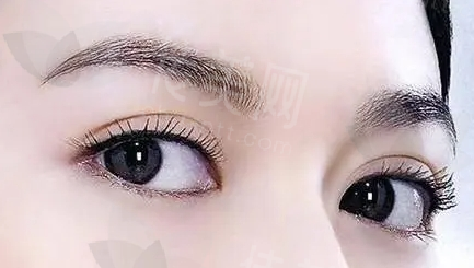 北京嘉禾李燕医生做双眼皮及眼修复技术好不好?高难度修复是特色,技术真的牛