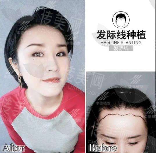 中德植发:一站式解决脱发困扰——专 业不只是医美