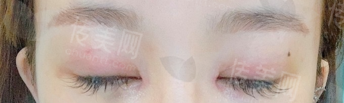 杭州好医院 杭州眼鼻修复整形哪里做的好?杭州上颜李观龙眼鼻高难度修复,网友评价效果非凡!