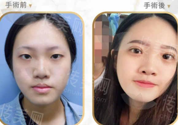 双眼皮2.jpg