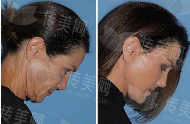 官方咨询:湖南永州的刘跃珠医生拉皮效果差?详情来了