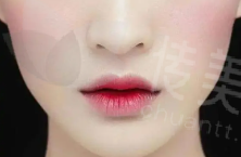 唇形矫正3.png