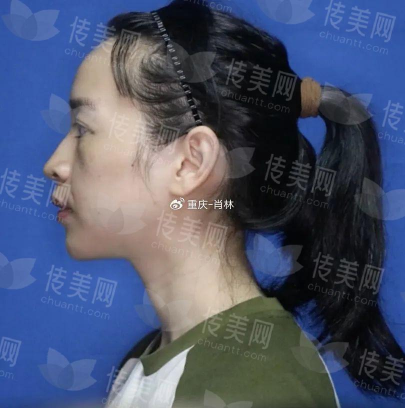颞下颌关节+双颌+颏成型手术分享,正颌对我来说是改变生活