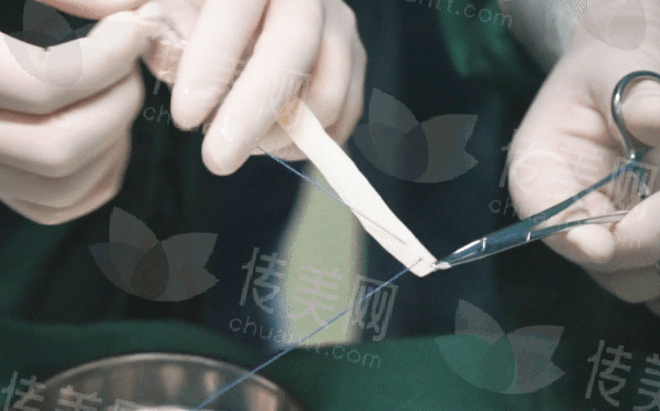 健康播报:3d生物束带紧缩术真的有效果吗?3d生物束带紧缩到几指?能维持几年?哪家医院3d生物束带手术做得好?