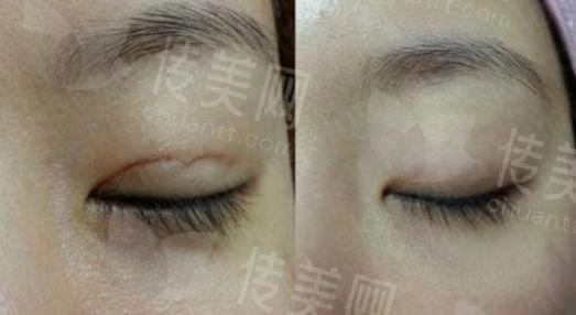 昆明双眼皮修复好的医生有哪些呢?焦圆华/金辉/李德庆实力强劲