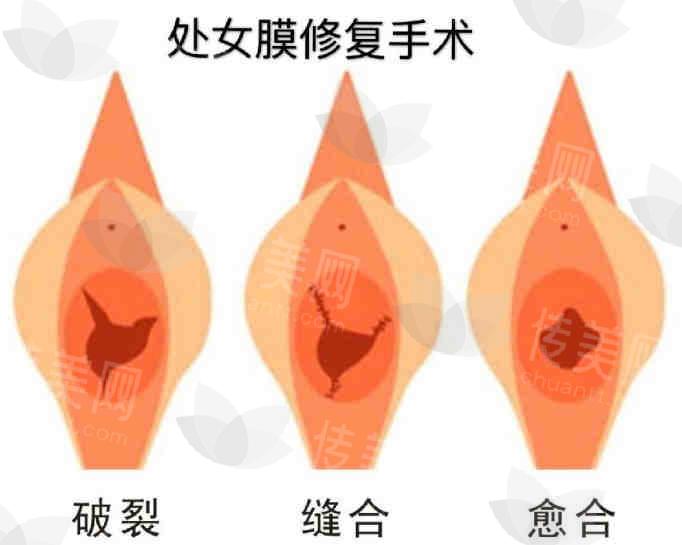 武汉哪个医生私密整形技术好?武汉硚口卓美曹玮医生处女膜修复紧缩针高潮针阴蒂包皮阴唇整形详情介绍,附手术地址