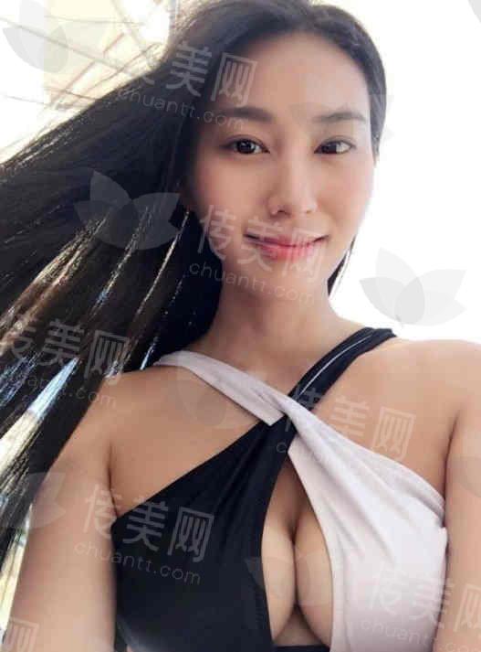 北京隆胸明星医生:北京英煌整形项力源/陈伟专家脂肪丰胸假体隆胸美观可靠,附手术地址