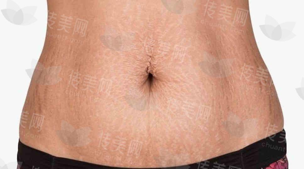 私密妊娠纹.jpg