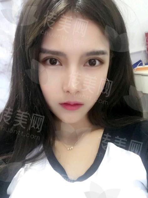 杭州美莱整形徐刚医生:揭秘金刀匠人的双眼皮技术,PMI睑缘切口双眼皮效果让人称赞!