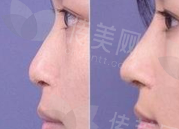 广州鼻修复隆鼻好医生排名推荐,广州医选整形刘震煊王芳娇价格6580元起附医院介绍&医生介绍&价格