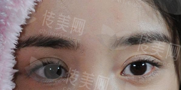 太原眼修复的好医院在哪里?眼修复整形价格表来咯