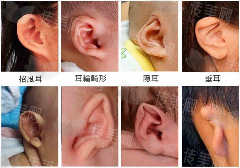 郑州整形大咖张正文医生耳畸形整复唇鼻畸形矫正、瘢痕修复、面部五官整形门诊详情:真实案例&坐诊医院&预约途径