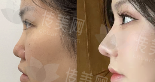 韶关做综合隆鼻肋骨软骨多少钱?好医生推荐第一人民医院莫伟粤北人民医院阳纯兵奢咖整形医院李三勇