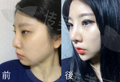 深圳鼻修复隆鼻好医生刘冰现在在哪坐诊?鲁班鼻精修鼻深圳鹏程整形附医院介绍&医生介绍&价格