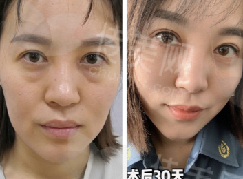 深圳双美胶原蛋白去黑眼圈填充泪沟好医生推荐,深圳鹏程整形唐航价格5000元起附医院介绍&医生介绍