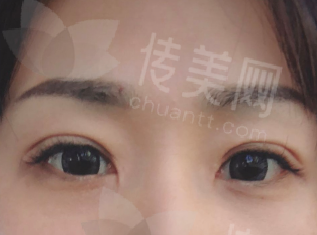深圳美莱整形做眼部整形眼修复双眼皮好医生推荐,陈磊何玮刘浩排名前三有保障效果好价格参考