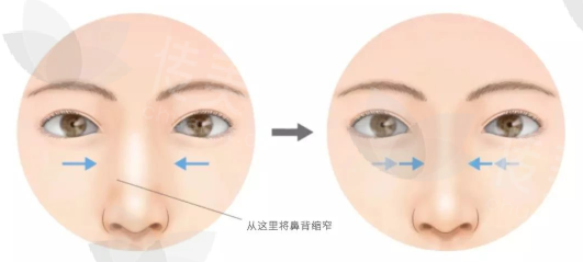 深圳鼻骨内推鼻修复口碑好医生推荐,深圳八大处张球俊深圳南华西晶张辉深圳宝丽李信峰