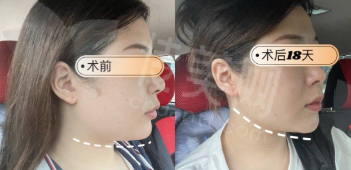 深圳做颈背吸脂塑形好医生推荐排名前三,深圳南华西晶整形舒畅深圳艺星整形黄海侠深圳鹏程李子鹏