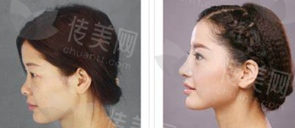 深圳博爱曙光整形做鼻综合鼻修复怎么样口碑效果好医生推荐,许国明价格9000元起附参考价格