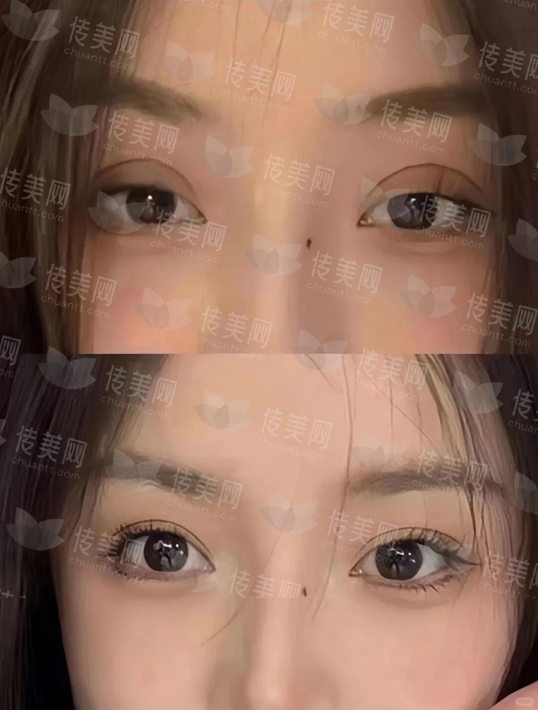 只有双眼皮做坏了的人才知道…_1_莱利整啥呢- MEB_来自小红书网页版.jpg