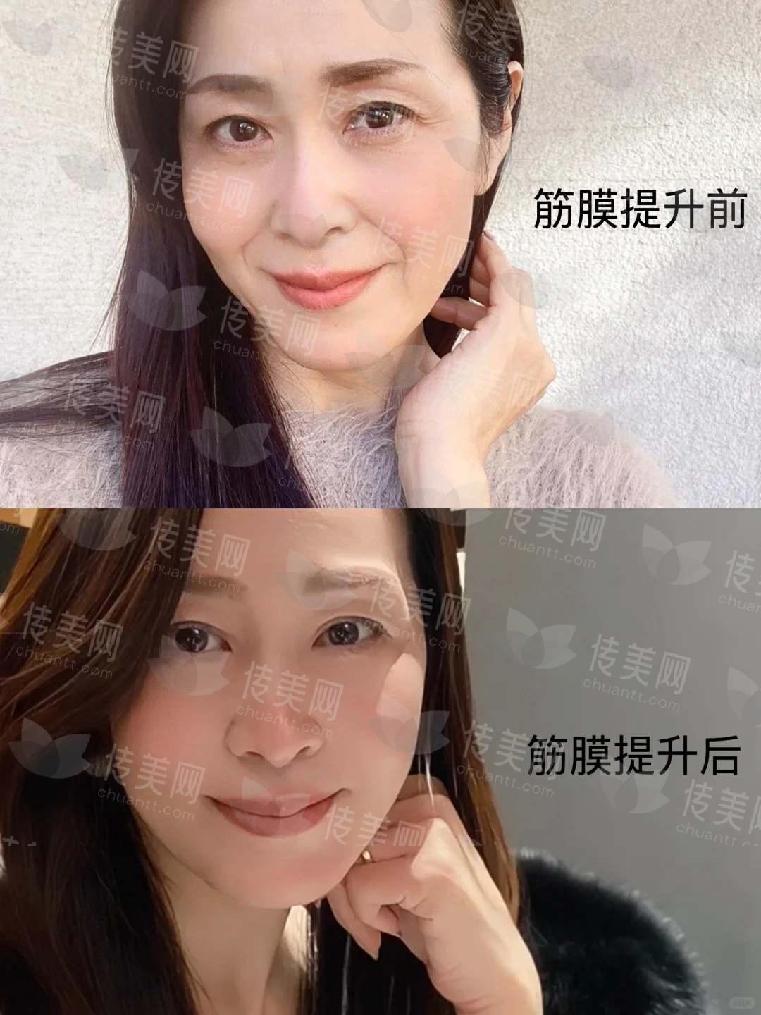 1736906004504931.jpg 50岁做了筋膜提升,<span style=