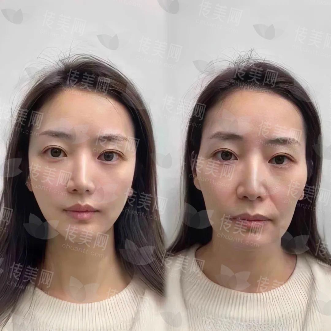 1736906056670139.jpg 筋膜提升后,说我30不过分吧_1_心比柠檬酸_来自小红书网页版.jpg