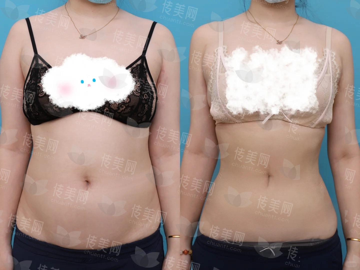 腰腹吸脂半年，小蛮腰这个赛道必须有我！_1_脂肪医生刘彦龙_来自小红书网页版.jpg