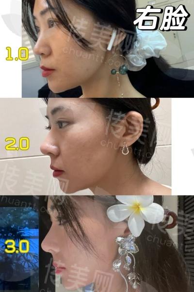 面中凹陷，我都做了什么_1_籽儿籽_来自小红书网页版.jpg