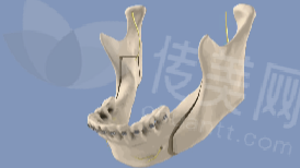 正颌手术