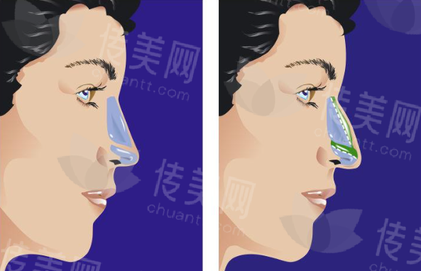 长沙鼻整形医生推荐