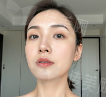 宜春名星（原华美）整形杨天明双眼皮修复案分享