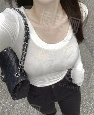 从A罩杯到C罩杯需要多少玻尿酸