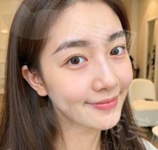 深圳美莱整形陈磊与刘昕双眼皮挂号热门原因：医生口碑