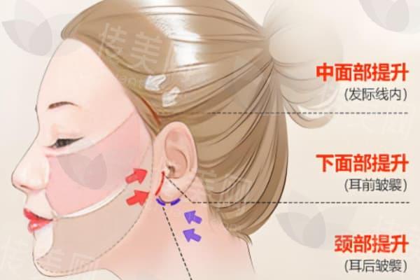 北京黄寅守拉皮手术多少钱?