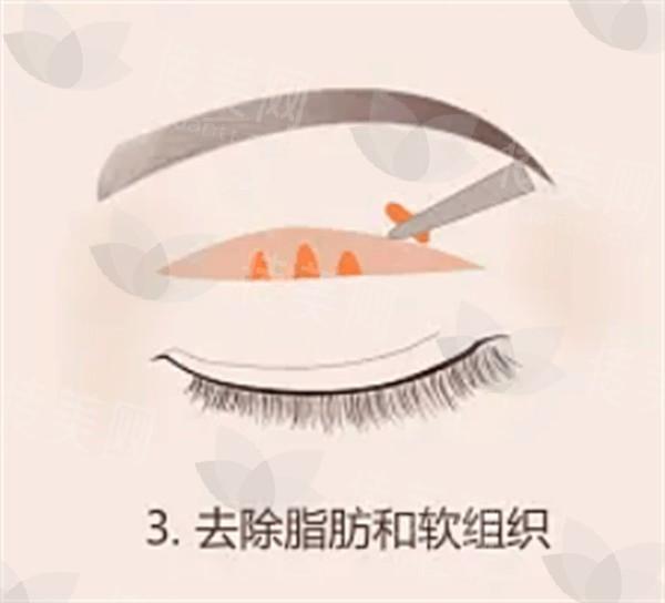 广州开眼角哪家医院好价格还不贵 排名上韩妃天河院/韩妃/医选挺出名