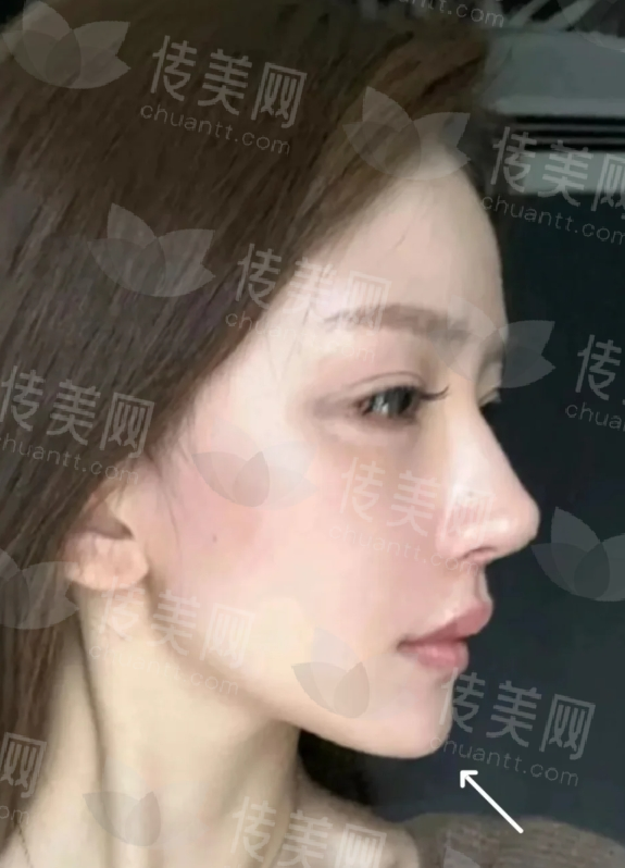 中山石岐区耳软骨鼻综合好医院推荐,爱思特整形医院中山市人民医院整形科中山韩妃整形口碑好案例多