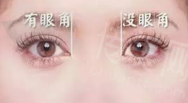卢尚兵口碑及开眼角技术详细解读