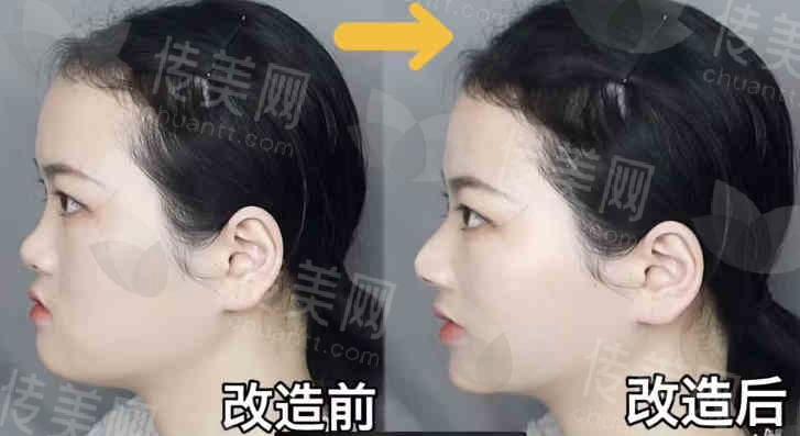 成都叶飞轮鼻修复:真实案例效果分享,医生技术实力大揭秘!