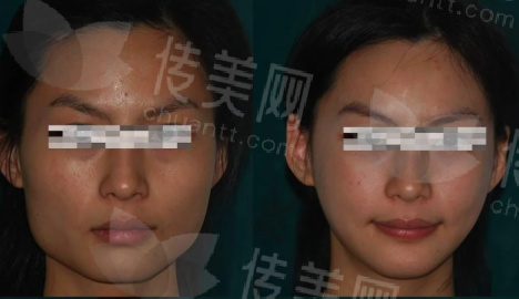 邱立东磨骨怎么样?北京圣嘉新邱立东磨骨个人资料、技术风格测评、案例曝光