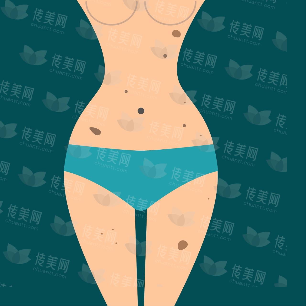 土麦森曹孟君吸脂案例详细解析,瘦大腿瘦小腿腰腹减脂效果好