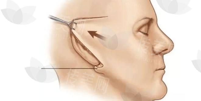上海拉皮专家推荐:苏薇洁、丁伟医生都值得信赖,附上海面部除皱价格参考表