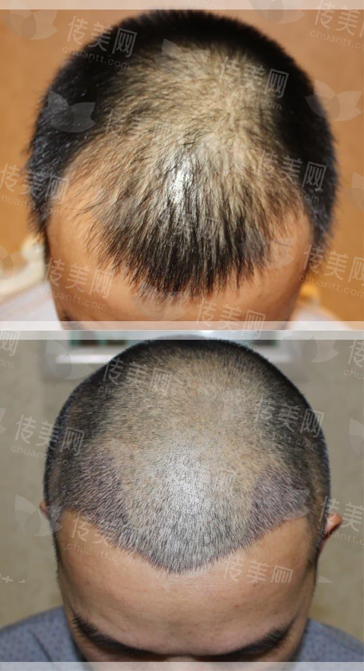 上海植发价格多少钱?微针植发价格贵吗?上海佳富美植发科朱玺医生植发效果如何?