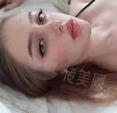 王明刚、甘泉涌都在合肥?揭秘合肥口碑最佳双眼皮医生!
