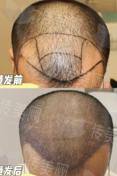 告别脱发烦恼!广州曙光植发医院:技术、价格、地址一览,预约咨询!