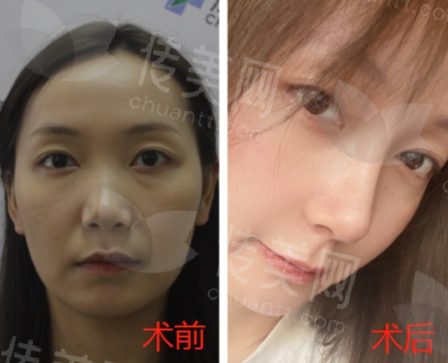成都美容整形医院双眼皮手术价格及医院优势解析
