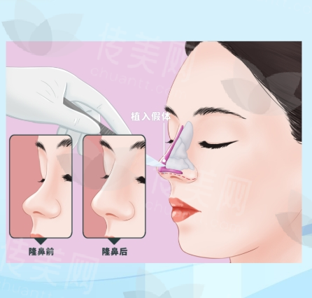 福州美贝尔整形医院做鼻子好吗?福州美贝尔医院简介-品牌荣誉分享