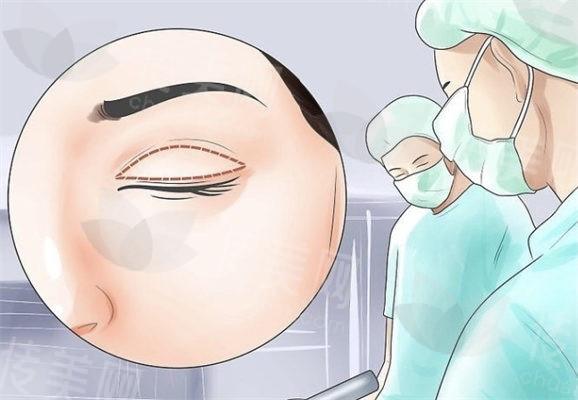 石家庄雅芳亚做双眼皮医生谁比较好?医院五大眼整形医生对比,无痕双眼皮价格5673元起
