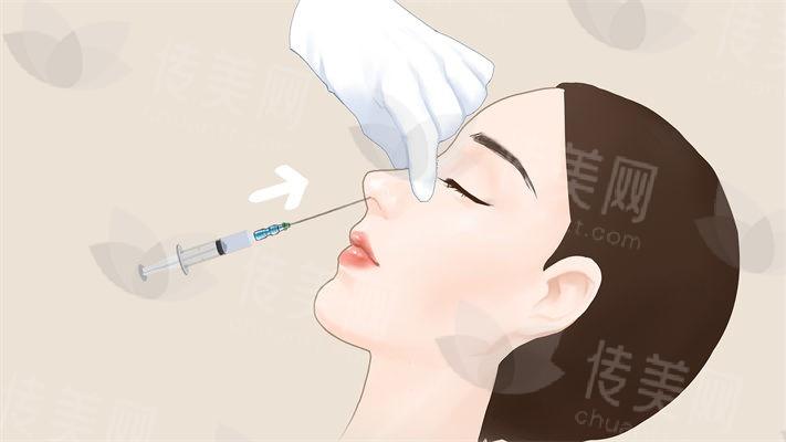 西安舒茂国医生做鼻子怎么样?医生介绍-鼻整形案例分享