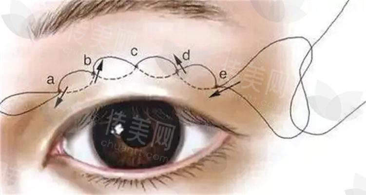 衡阳雅美整形廖伟龙医生介绍:擅长双眼皮、隆鼻、祛眼袋等,眼整形案例分享